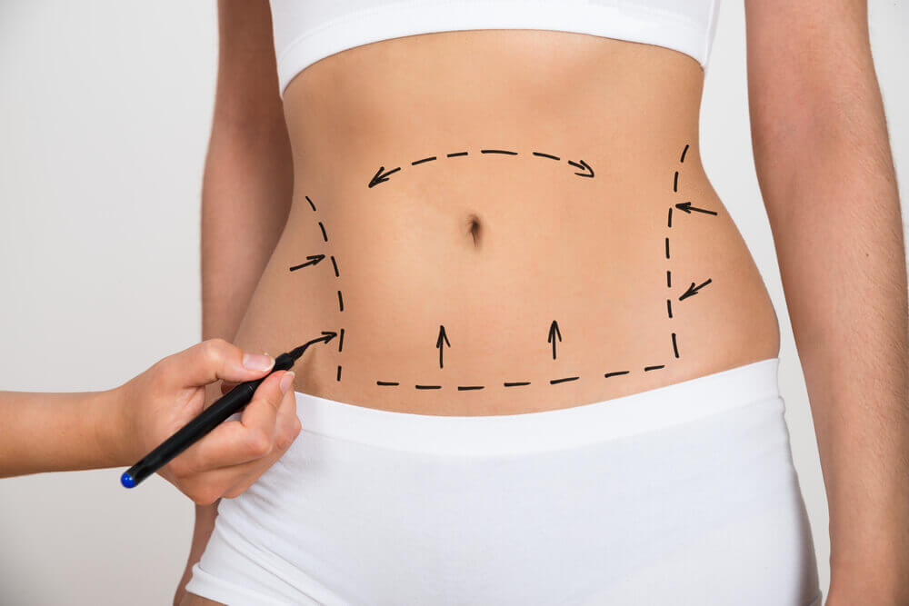 Pós-cirúrgico da Abdominoplastia