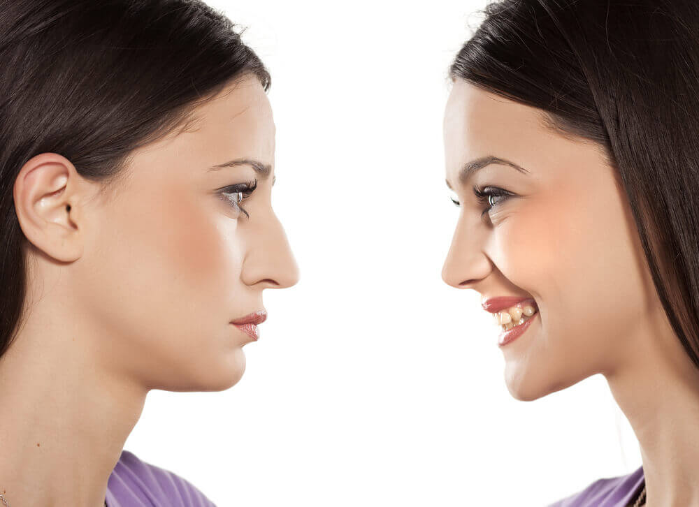 rinoplastia_secundaria