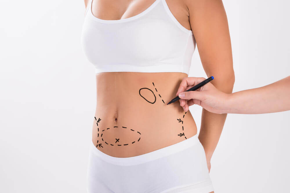 cirurgia de Abdominoplastia