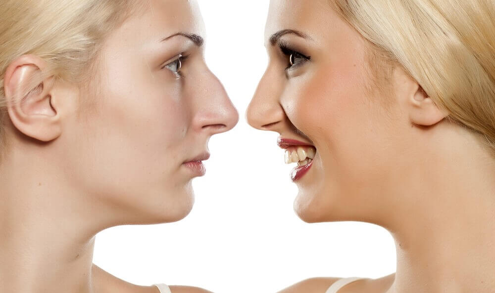 Rinoplastia estruturada x rinoplastia redutora