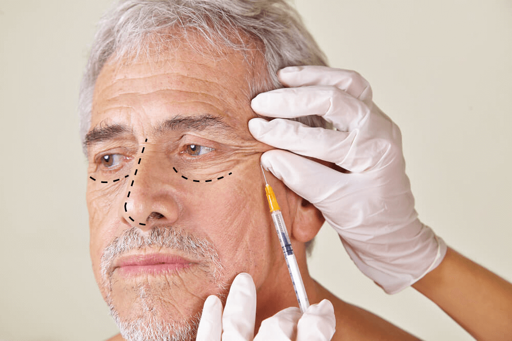 rinoplastia-em-idosos