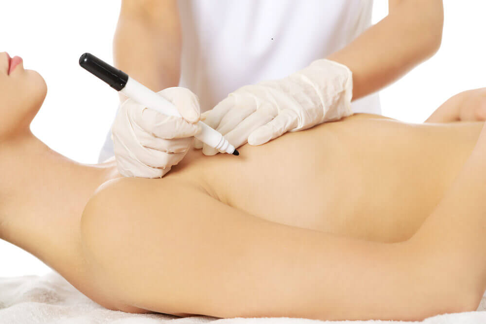 Mamoplastia