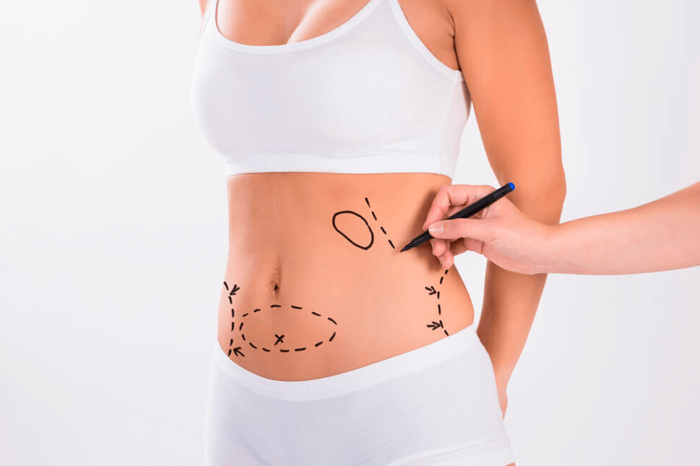 abdominoplastia