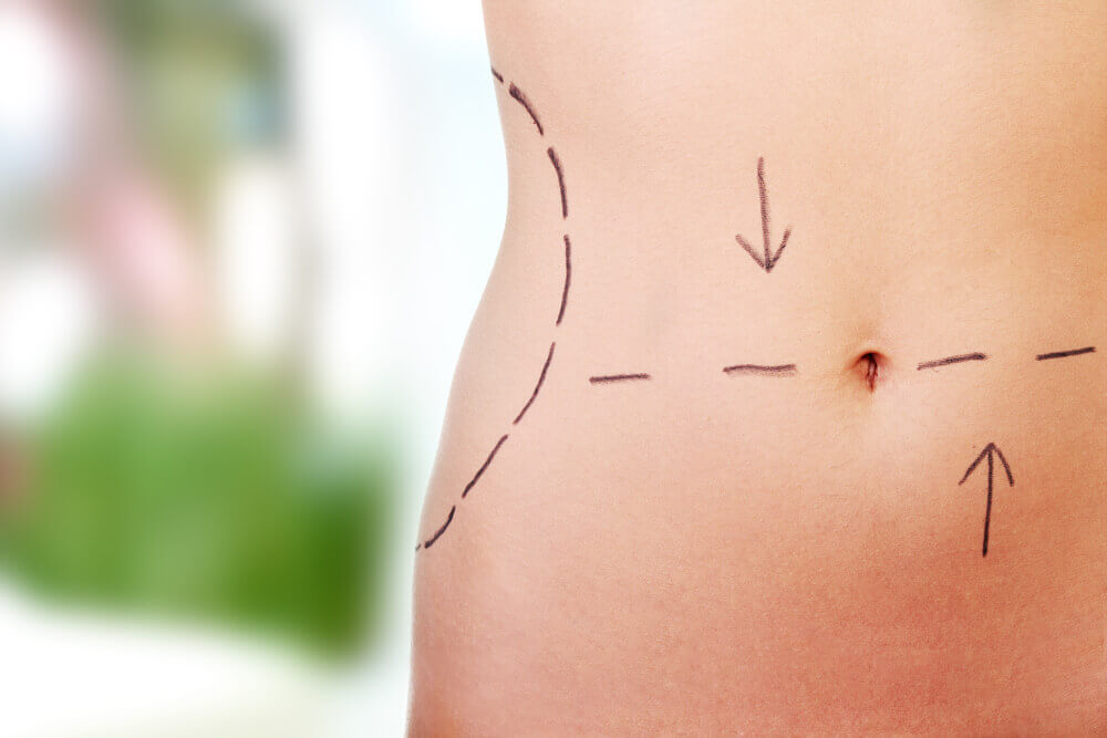 lipoaspiracao