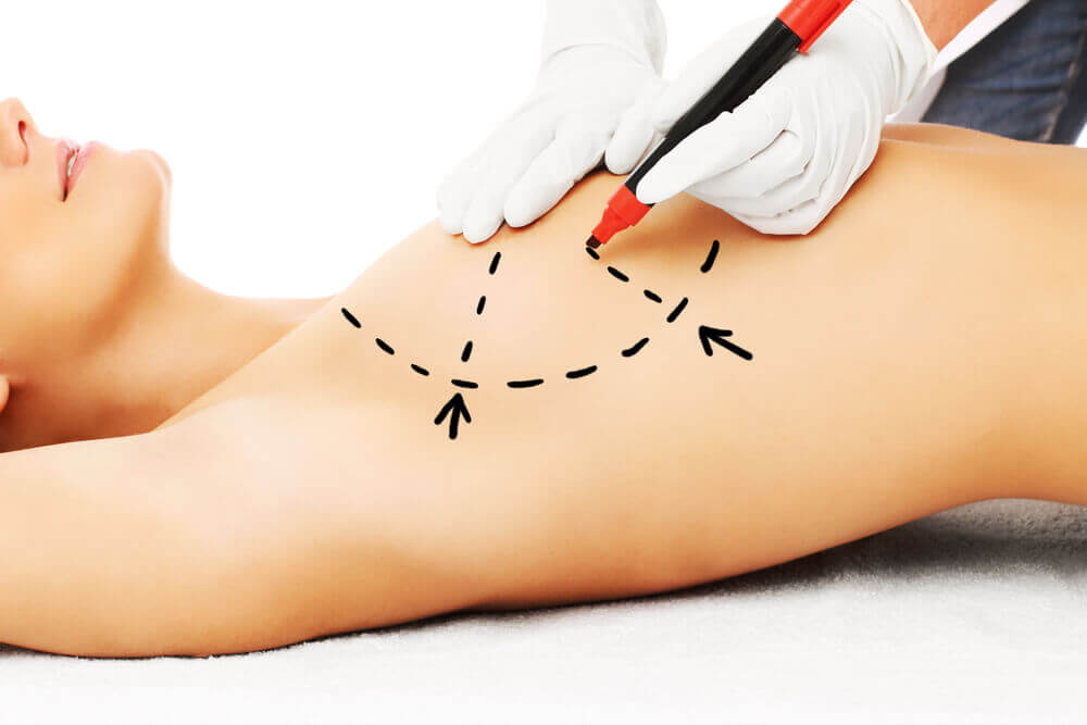 mamoplastia