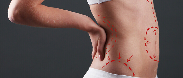 Conheça os diferentes tipos de lipoaspiração | Dr. Mário Farinazzo