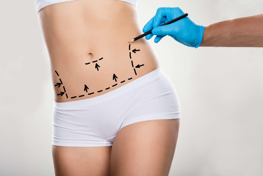 como-se-preparar-para-a-abdominoplastia?