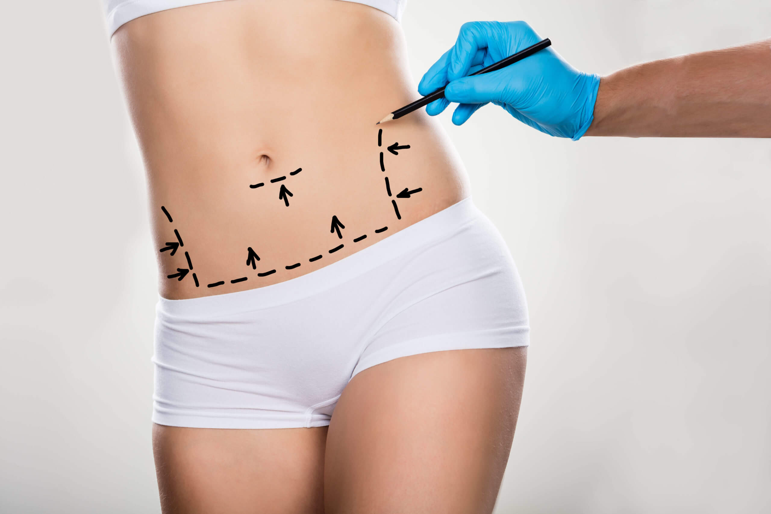 como-se-preparar-para-a-abdominoplastia?