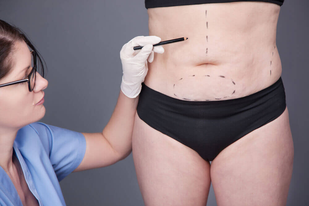abdominoplastia em ancora