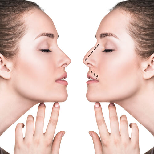 dorso nasal