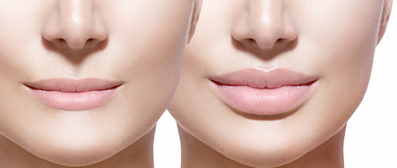 preenchimento labial