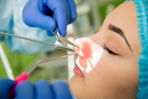 Rinoplastia