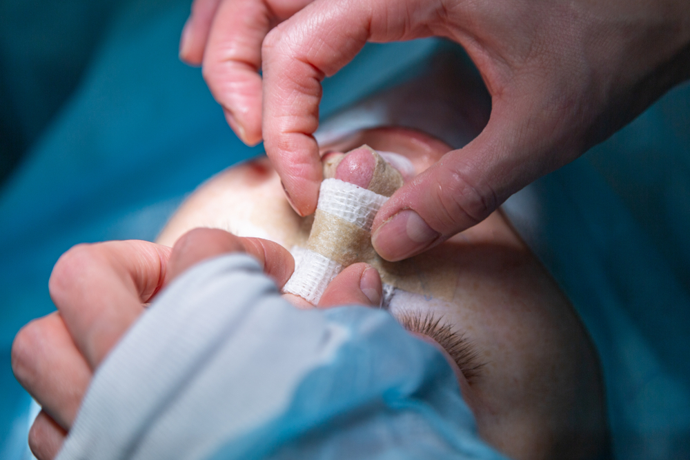 Cirurgia de rinoplastia preservadora