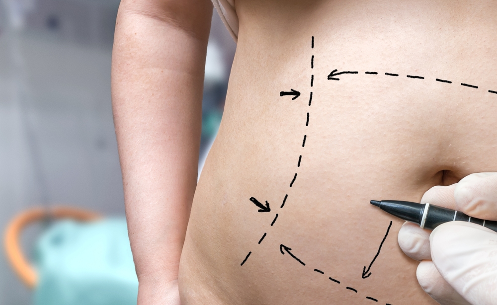 Marações no corpo da paciente para realização de uma abdominoplastia