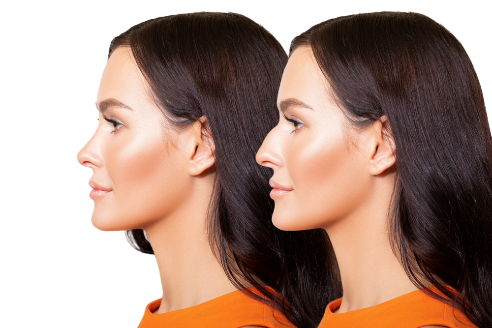Antes e depois de uma cirurgia de rinoplastia