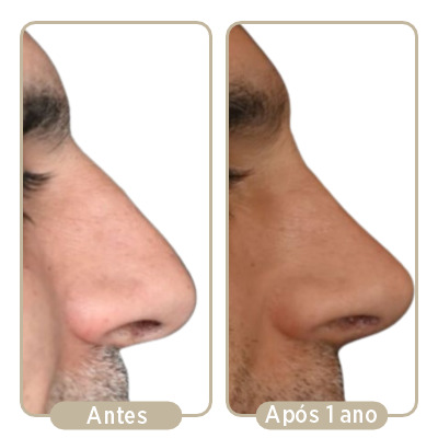 Antes e depois (após 1 anos) da rinoplastia.