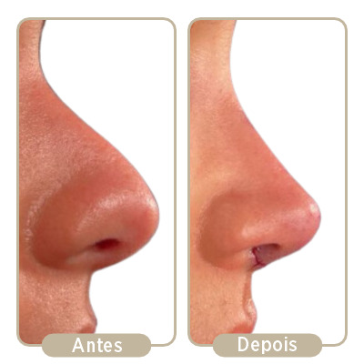 Antes e depois da rinoplastia.