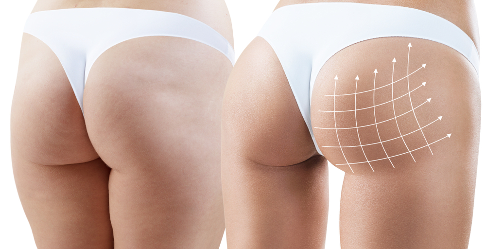 Antes e depois da gluteoplastia