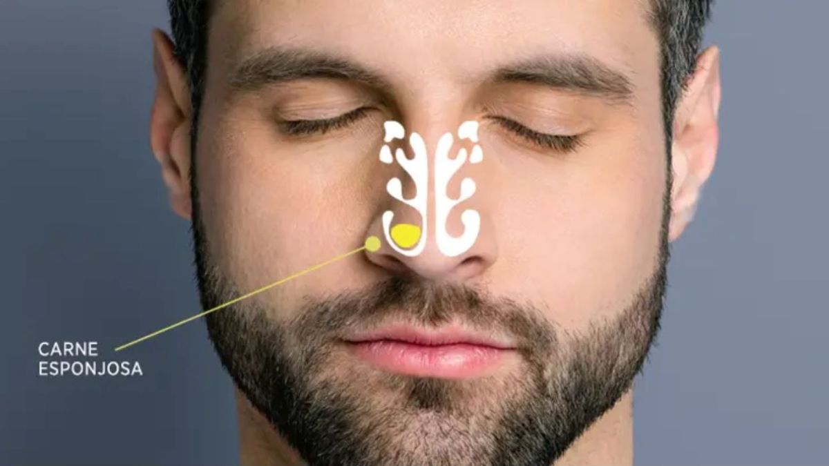 Paciente com olhos fechados e indicação de carne esponjosa no rosto