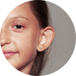 Otoplastia