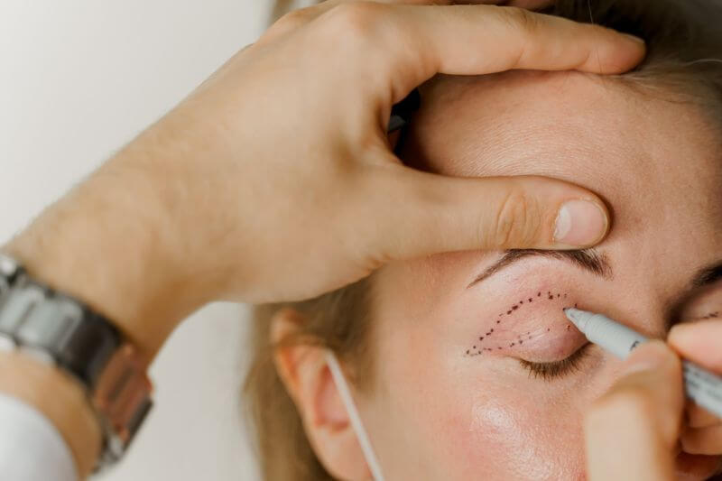 Cirurgião plástico fazendo marcação para blefaroplastia