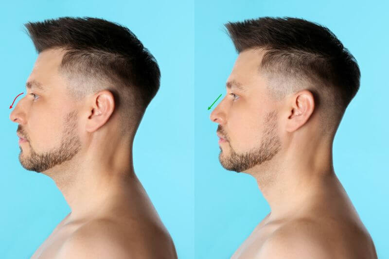 Fotos de perfil de um homem antes e depois da rinoplastia