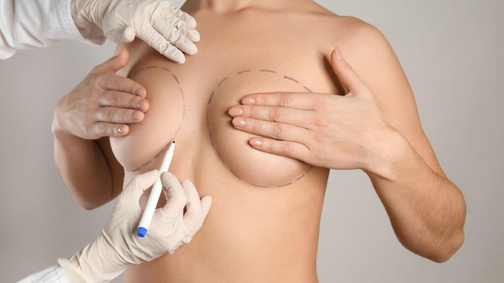 Mastopexia: o que é e como funciona a correção das mamas