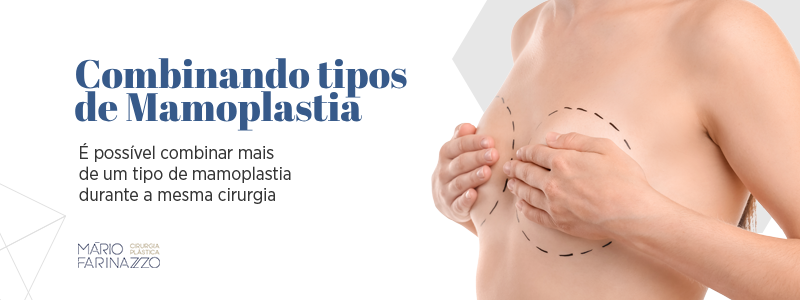 Combinando tipos de Mamoplastia: é  possível combinar mais de um tipo de mamoplastia durante a mesma cirurgia.