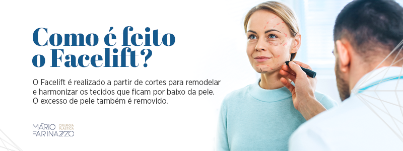 Como é feito o Facelift? O Facelift é realizado a partir de cortes para remodelar e harmonizar os tecidos que ficam por baixo da pele. O excesso de pele também é removido.